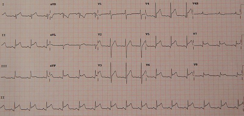 File:PericarditisMyocarditis.jpg