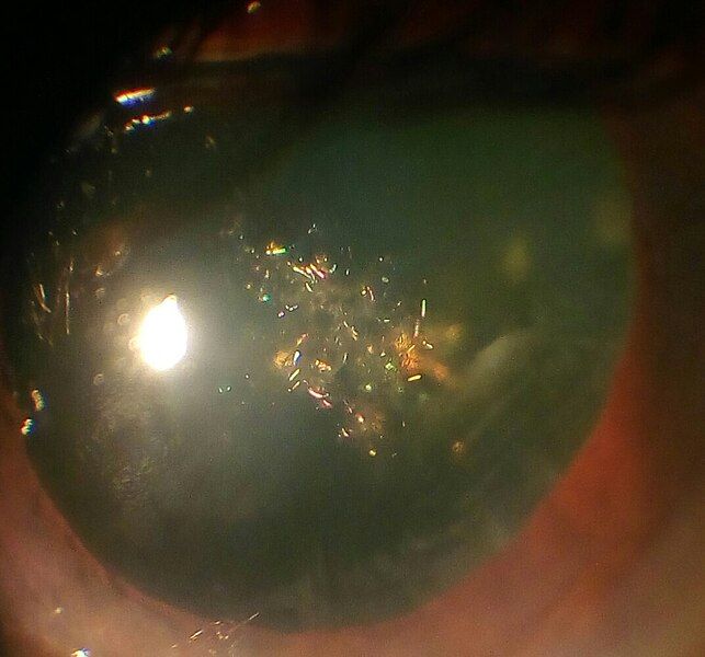 File:Chrismas tree cataract.jpg