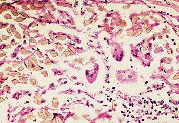 "Foreign body giant cell reaction to nylon suture material"