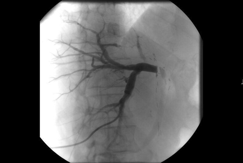 File:Biliary stenosis.tif