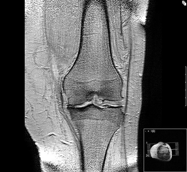 File:Gonarthrose-Knorpelaufbrauch.jpg