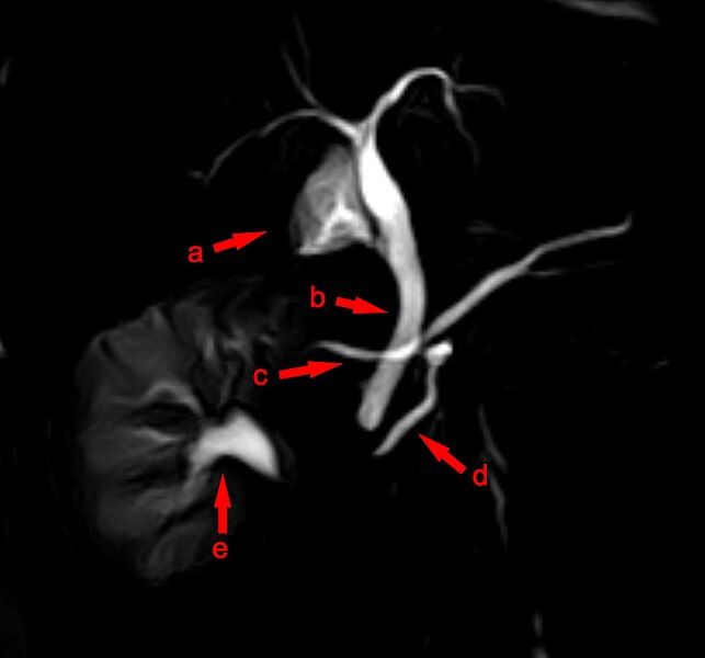 File:MRCP Pankreas divisum.jpg