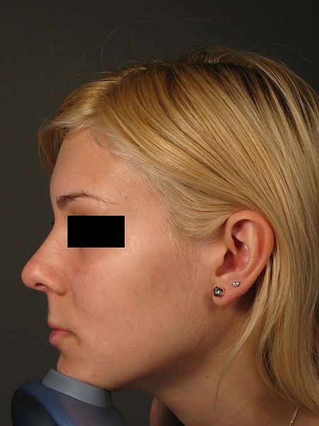 File:2rhinoplastyafter.jpg