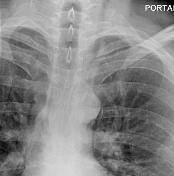 File:CXR Pneumomediastinum.jpg