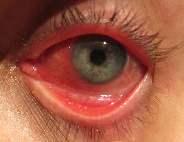 File:Conjuntivitis (RPS 03-06-2015).png