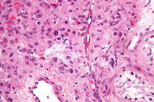 High magnification micrograph of a Leydig cell tumour. H&E stain.