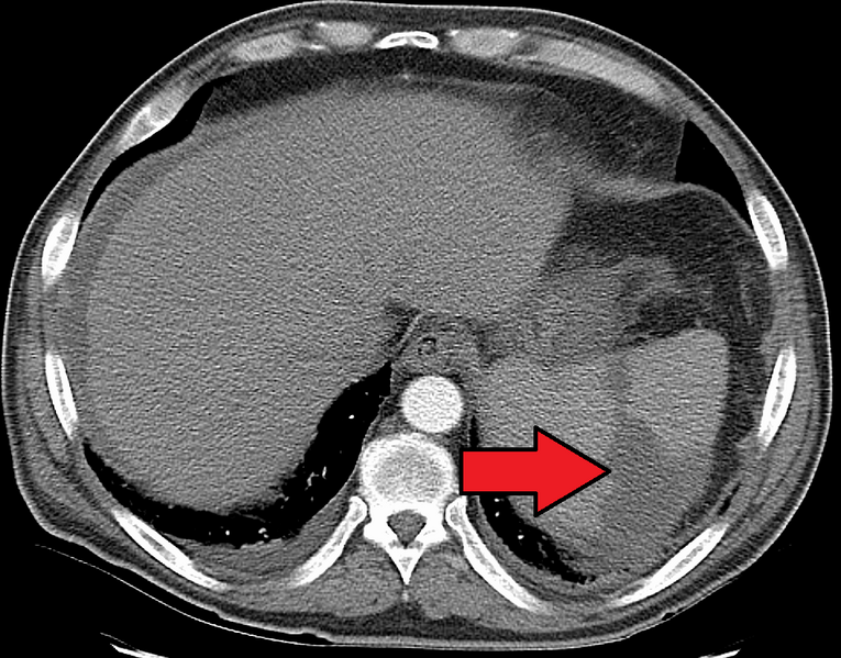 File:SplenicInfarctMark.png