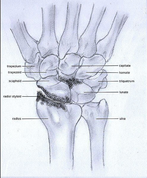 File:Stadium3osteoathritis.JPG