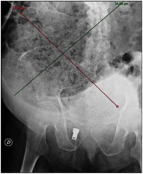 File:Journal.pmed.1000092.g002 fecal impaction.png