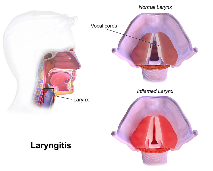 File:Laryngitis.png