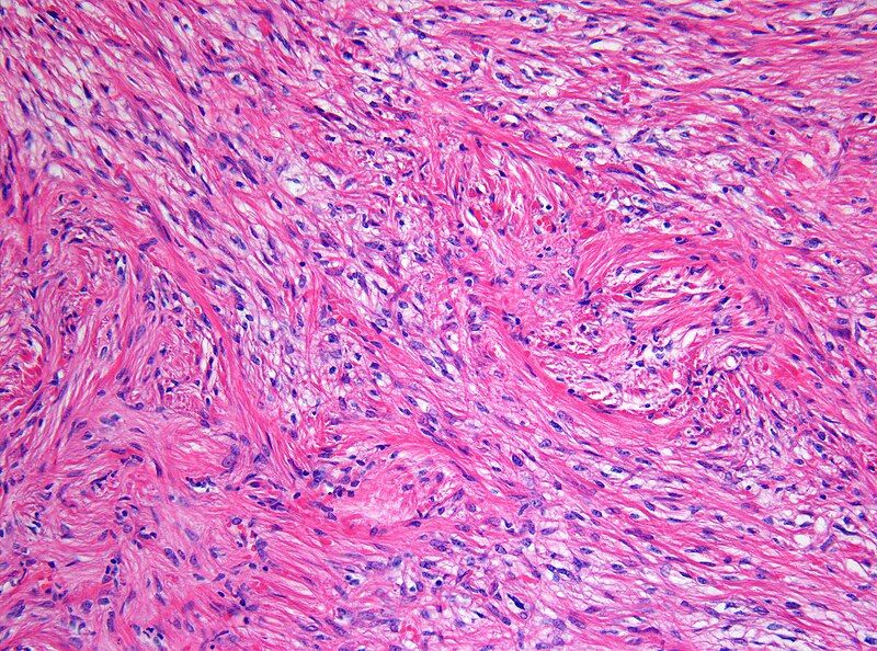 File:PilocyticAstrocytoma 20x HE.jpg