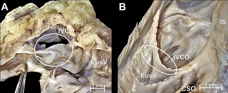 File:Eustachian valve.jpg