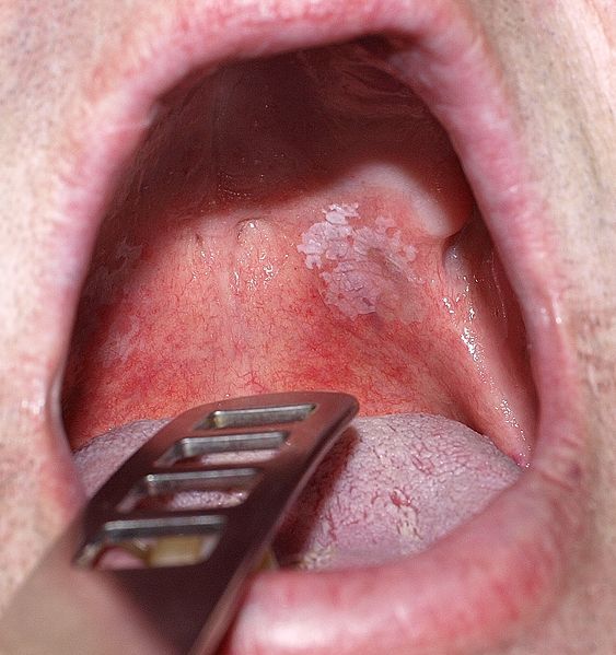 File:Orale Leukoplakie.jpg