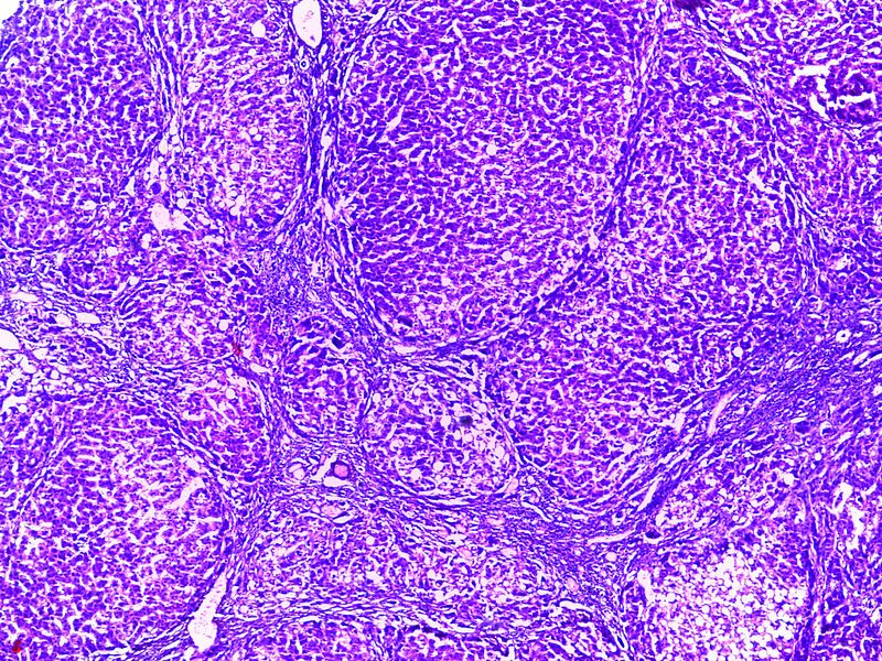 File:Cirrhosis Liver 4x.jpg