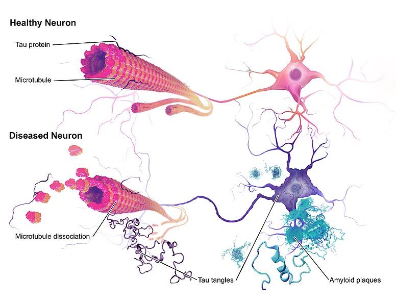 File:Alzheimers Disease.jpg