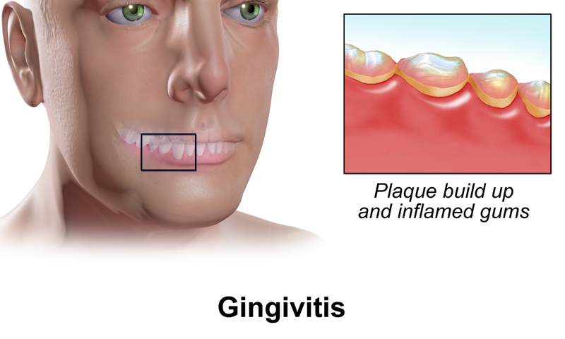 File:Gingivitis.png