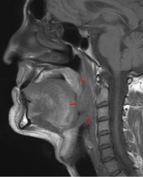 File:OropharyngealCancer, 2017, 2,16-30.svg