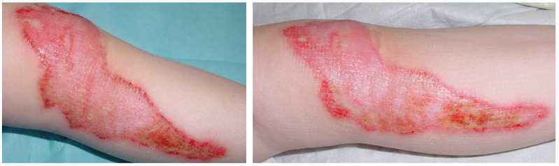 File:WIRA-Wiki-GH-009-Burn-wound-improvement-with-wIRA.png