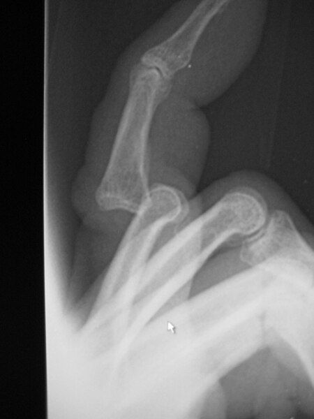 File:PIPjointdislocation2008.jpg