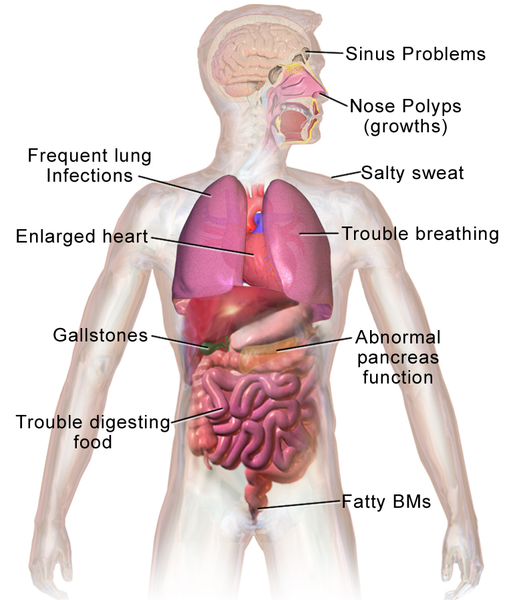 File:Blausen 0286 CysticFibrosis.png