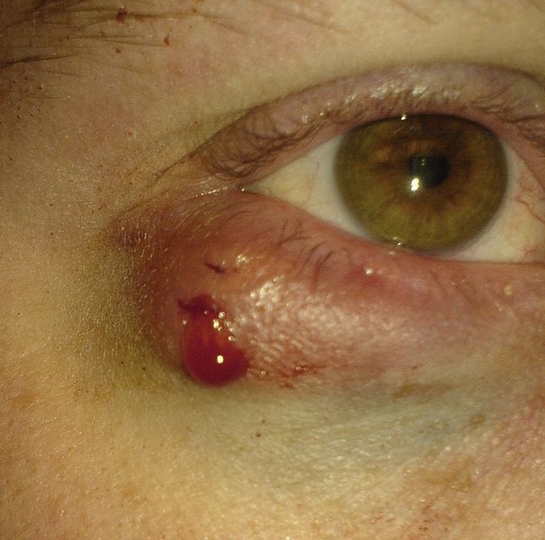 File:Chalazion (Excised) 02.jpg