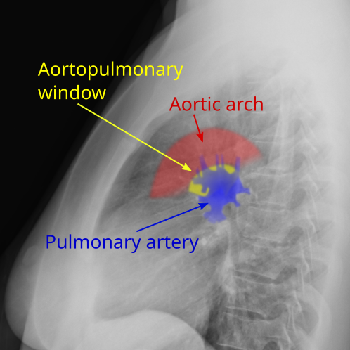 File:Aortopulmonary window.svg