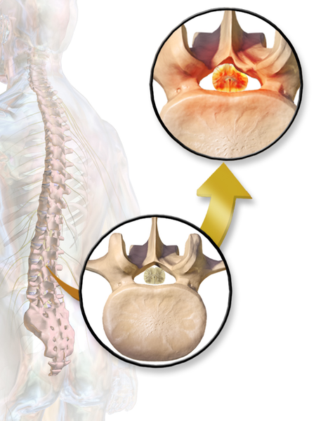 File:Spinal Stenosis.png