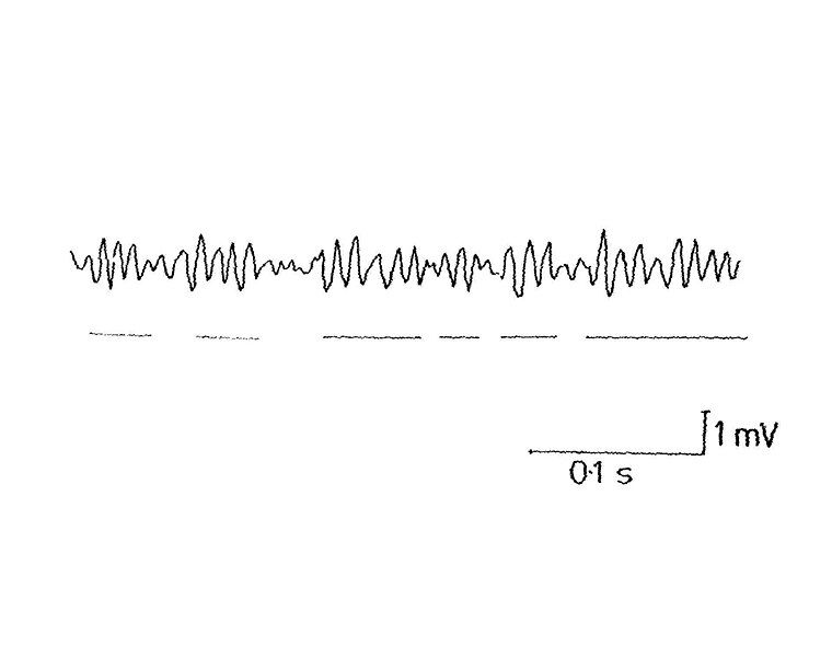 File:Tremblement oculaire.jpg