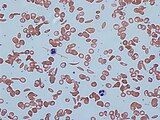 Red blood cells in sickle cell anaemia