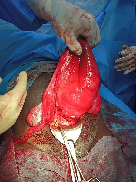 File:An atonic uterus.jpg