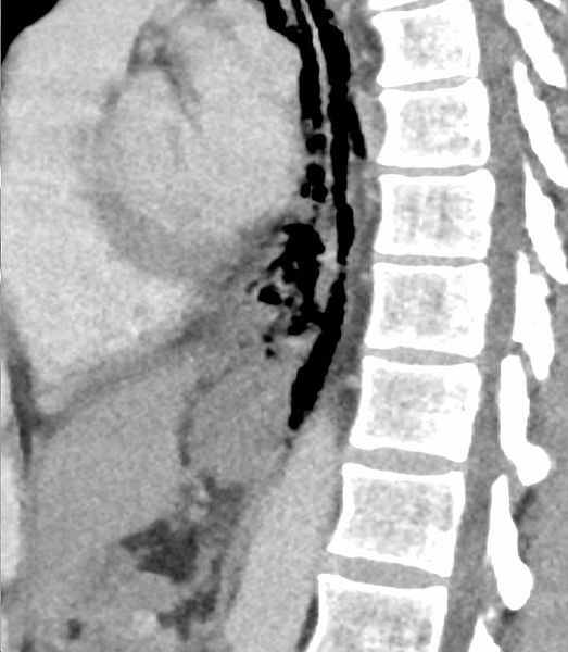 File:BoorhaaveSag CT.JPG