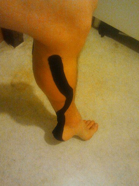 File:Kinesiotaping.jpg