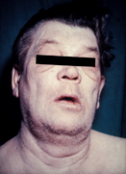 File:Myxedema face.png