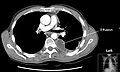 CT scan of the chest showing a left-sided pleural effusion. The fluid usually settles at the lowest space due to gravity; in this case, at the back because the patient is supine.