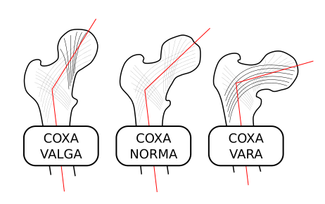 File:Coxa-valga-norma-vara-000.svg