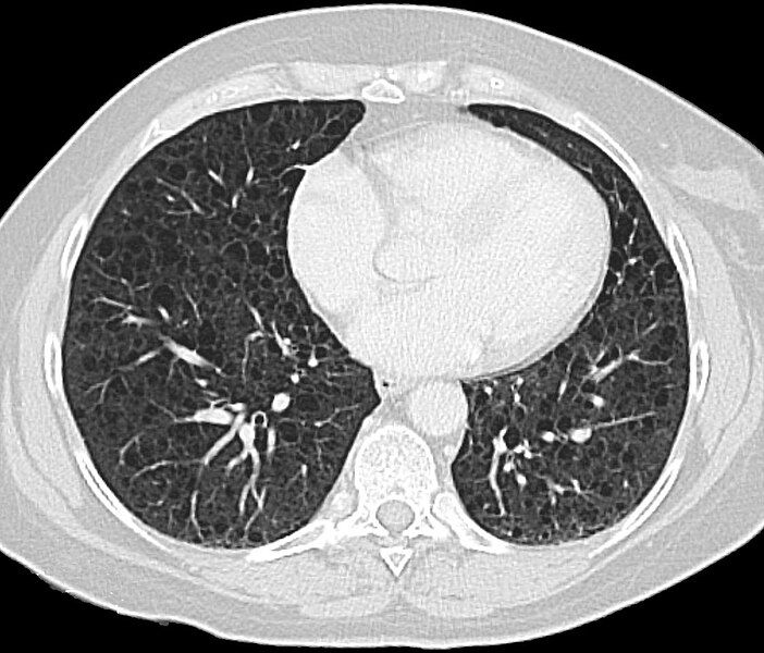 File:Lymphangioleiomyomatose CT.jpg