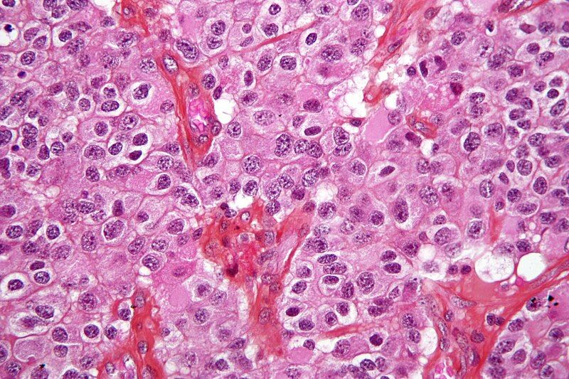 File:Oligodendroglioma1 high mag.jpg