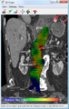 Biomechanical AAA rupture risk prediction