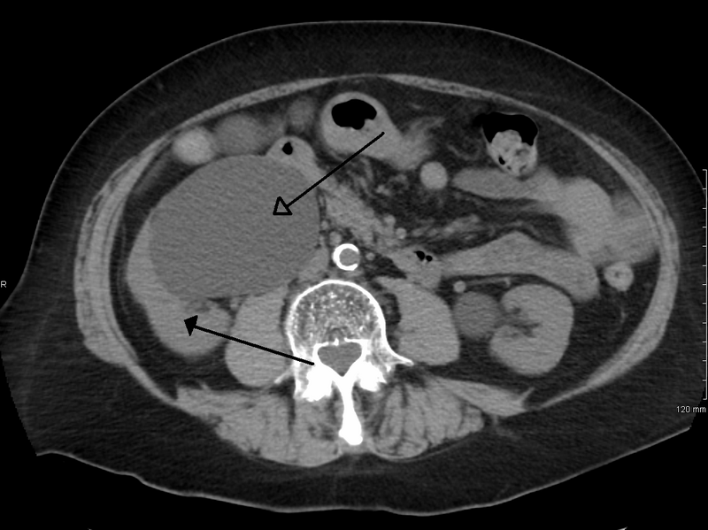 File:Hydronephrosis.png