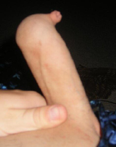 File:Phimosis Penis.jpg