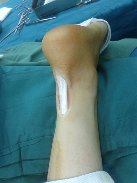 File:Achilles tendon 01.jpg