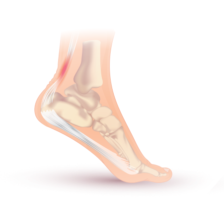 File:Achilles tendonitis.svg