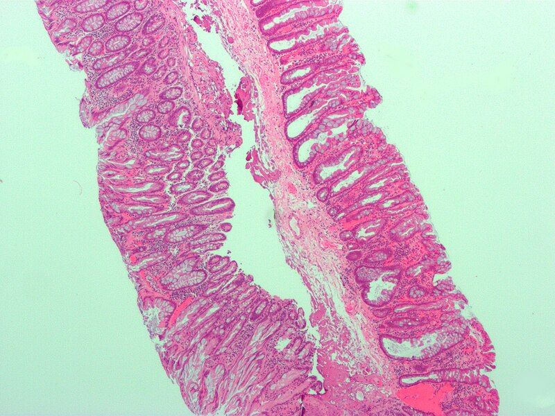 File:Sessile serrated adenoma.jpg