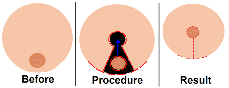 File:Breastreduction.PNG