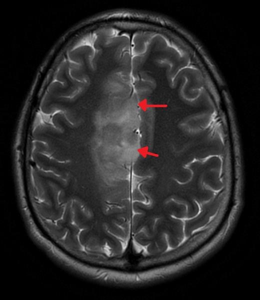 File:MRIOligoastrocytoma.png