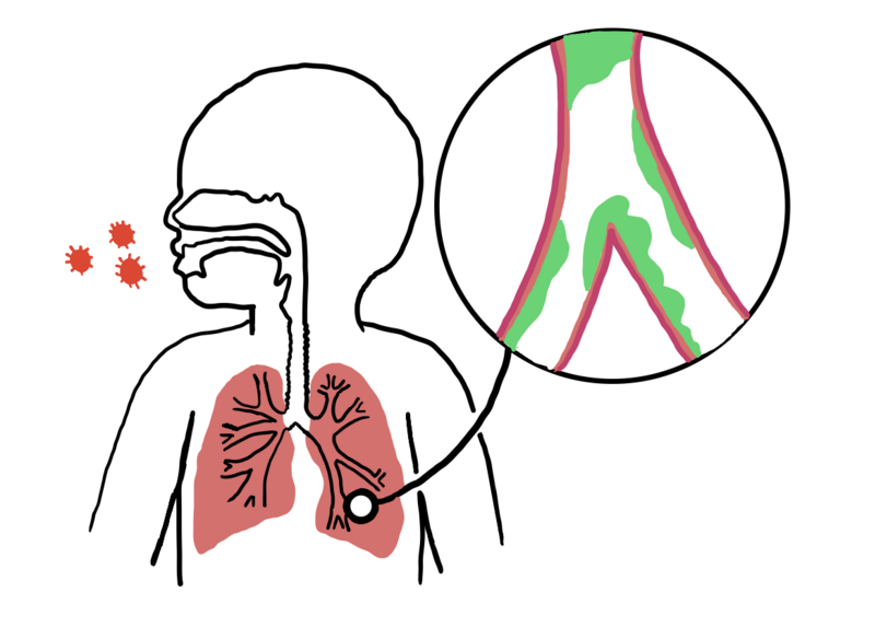 File:Bronchiolitis Medical Image.png