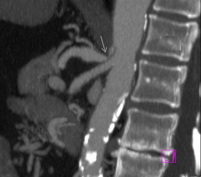 File:Coeliacus compression cta.JPG