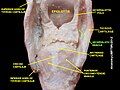 Aryepiglotic muscle