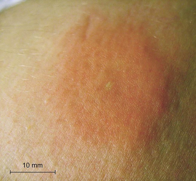 File:Bee-sting-piqure-abeille-scale-2.jpg