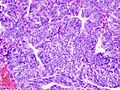 Endometrioid adenocarcinoma from biopsy. H&E stain.